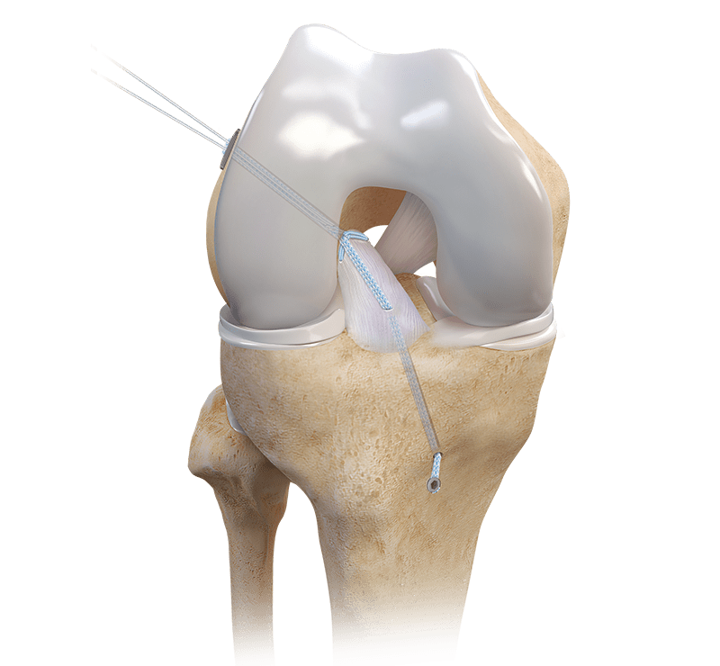 公式通販サイトセール Arthrex Sutures FiberRing™ With Implant TightRope® Repair ACL - 健康・医学